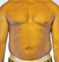 Liposuction Before and After Pictures Houston, TX