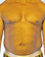 Abdominal Etching Before and After Pictures Houston, TX