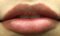 Lip Injections Before and After Pictures Houston, TX