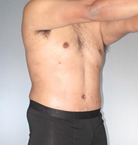 Liposuction Before and After Pictures Houston, TX