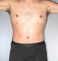 Tummy Tuck Before and After Pictures Houston, TX