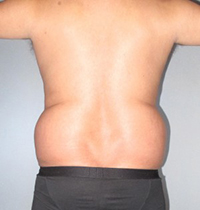 Liposuction Before and After Pictures Houston, TX