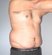 Liposuction Before and After Pictures Houston, TX