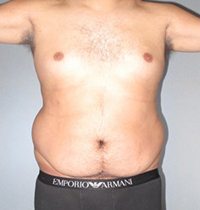 Tummy Tuck Before and After Pictures Houston, TX