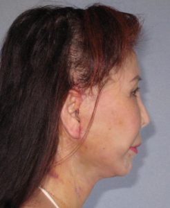 Facelift Before and After Pictures Houston, TX