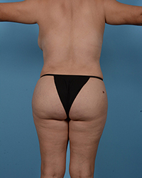Brazilian Butt Lift Before and After Photos, Houston, TX