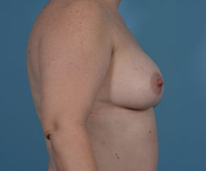 375cc, silicone, silicone implants, breast augmentation