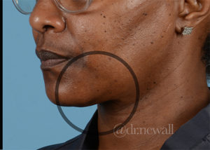 Neck Liposuction Before and After Pictures Houston, TX